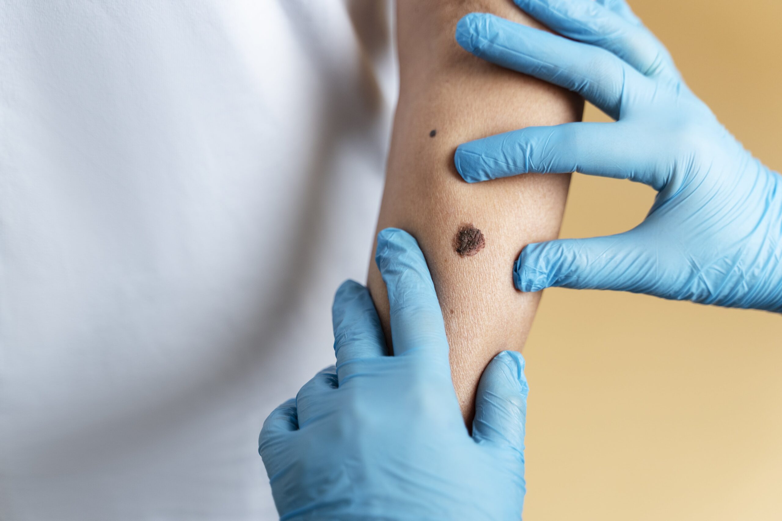 Control alunițe la medic dermatolog – evaluare completă a pielii